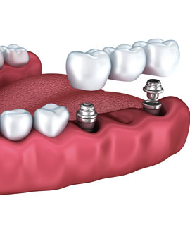 Las prótesis sobre implantes son las coronas, puentes o prótesis completas que se colocan encima del implante osteointegrado.
  Coronas sobre implantes: Pueden sustituir uno o varios dientes, estas sustituyen las coronas de los dientes naturales perdidos.
  Sobredentadura: Son prótesis removibles como las dentaduras postizas de toda la vida que se colocan sobre implantes dentales.
  Prótesis fija sobre implantes: Se trata de las prótesis dentales de arcada completa que se fijan atornilladas o cementadas sobre implantes osteointegrados.