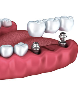 Las prótesis sobre implantes son las coronas, puentes o prótesis completas que se colocan encima del implante osteointegrado.
  Coronas sobre implantes: Pueden sustituir uno o varios dientes, estas sustituyen las coronas de los dientes naturales perdidos.
  Sobredentadura: Son prótesis removibles como las dentaduras postizas de toda la vida que se colocan sobre implantes dentales.
  Prótesis fija sobre implantes: Se trata de las prótesis dentales de arcada completa que se fijan atornilladas o cementadas sobre implantes osteointegrados.