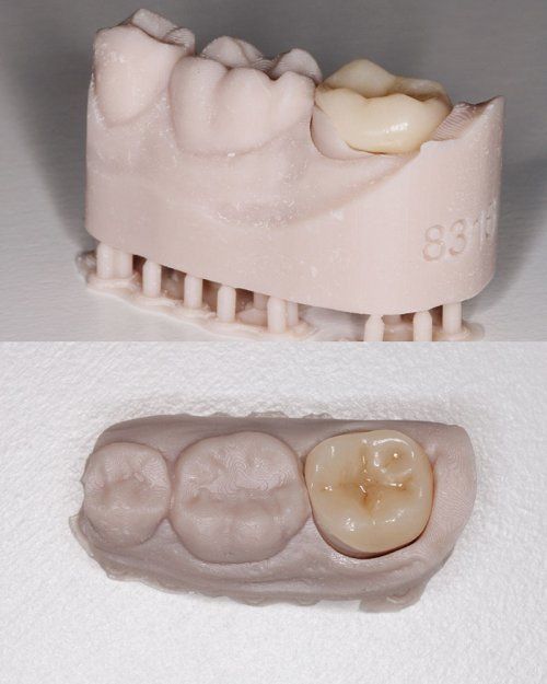 incrustación dental