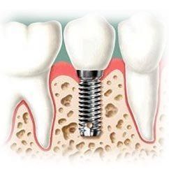 implante-dental (1).jpg
