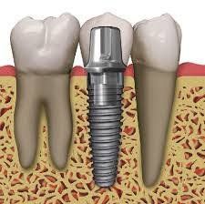 Un implante dental es un sustituto artificial de la raíz natural del diente