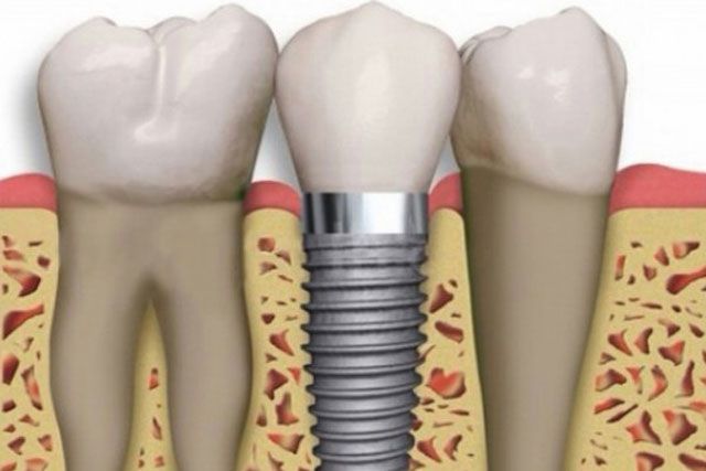 Implantología dental