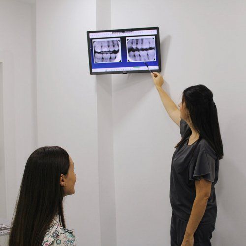 Caries dental