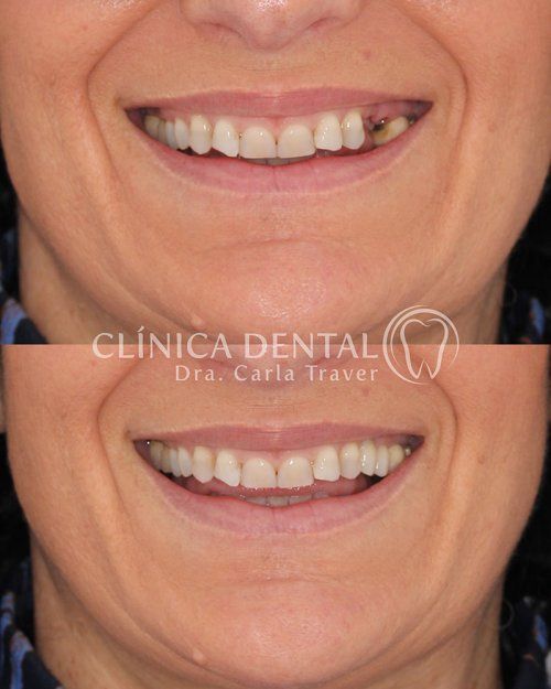 PRÓTESIS SOBRE IMPLANTES