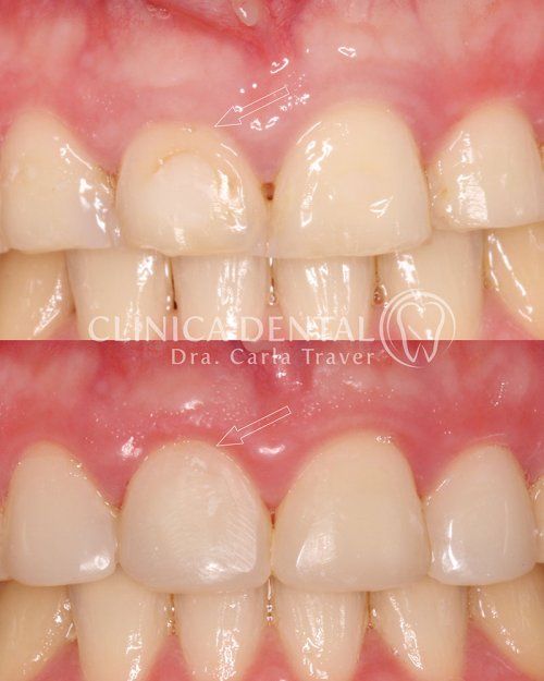GINGIVECTOMIA