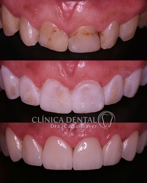 CARILLAS DENTALES