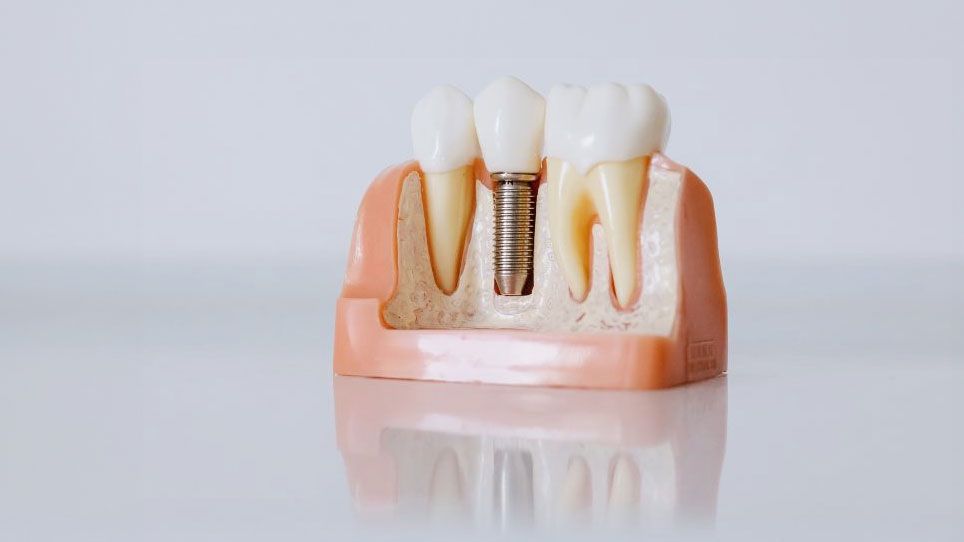 Implantología y rehabilitación