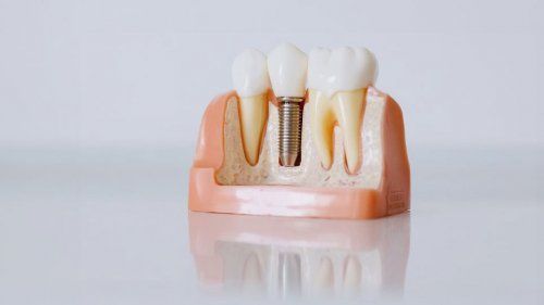 Implantología y rehabilitación