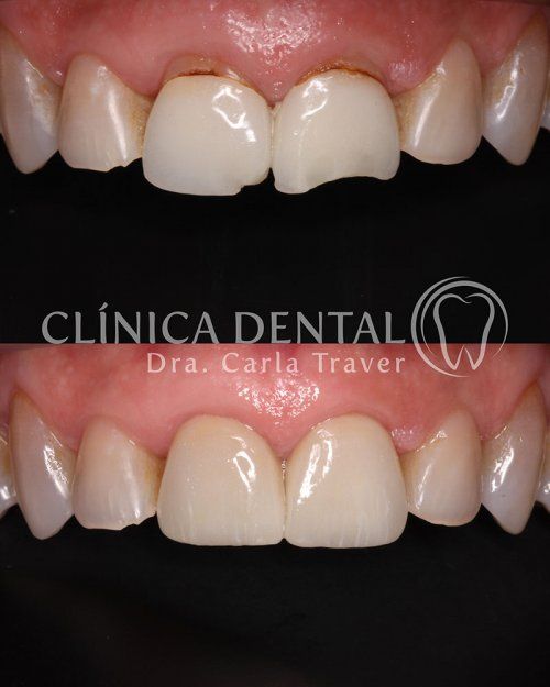 CORONAS DE PORCELANA