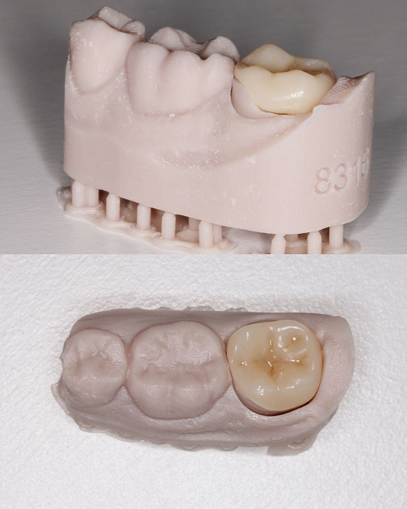 Incrustación dental Incrustación dental