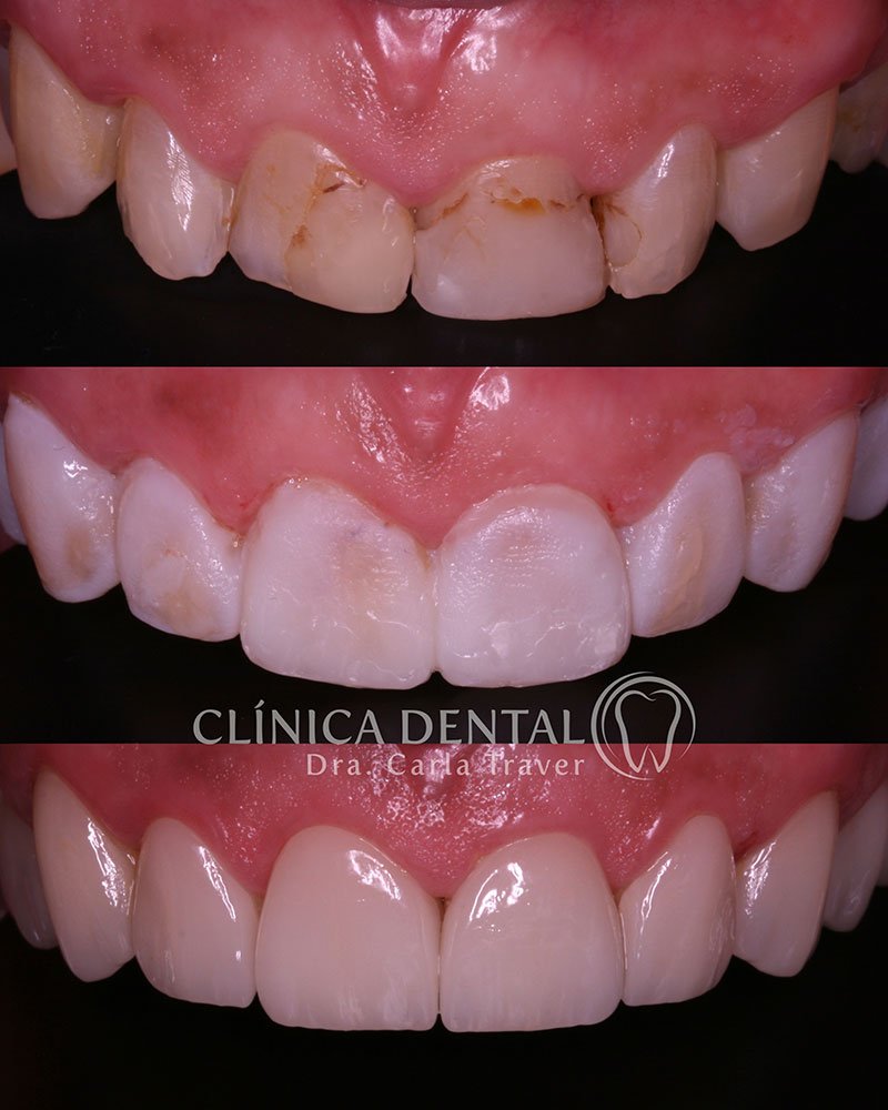 Carillas dentales Carillas dentales
