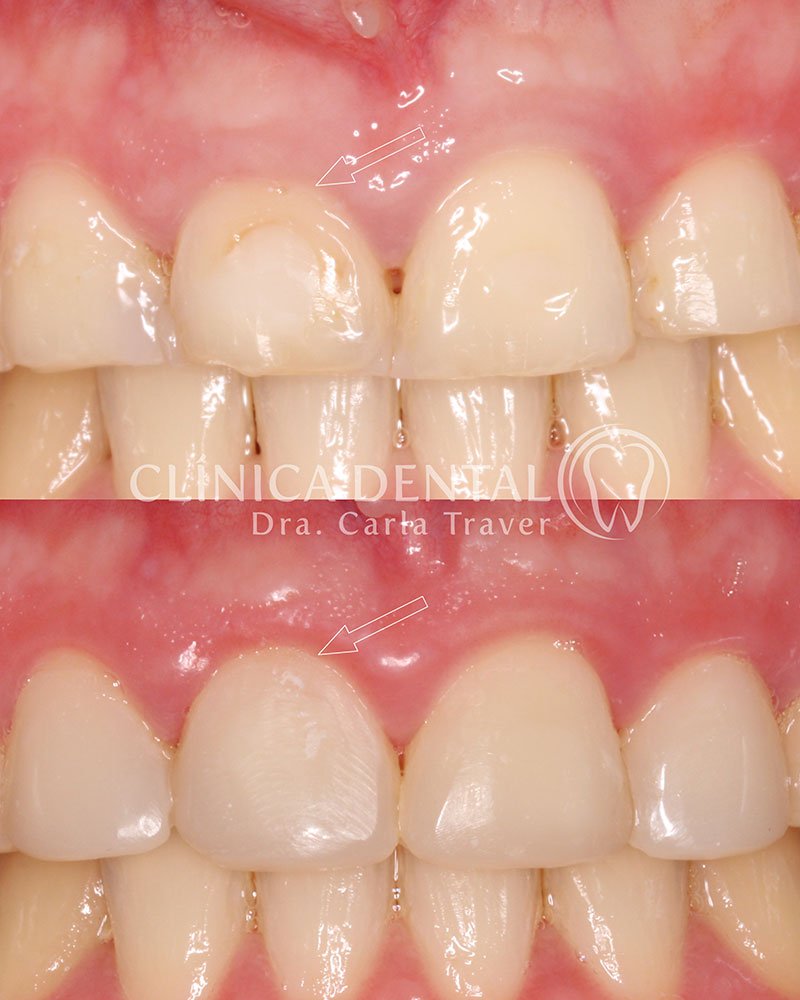 Gingivectomía Gingivectomía